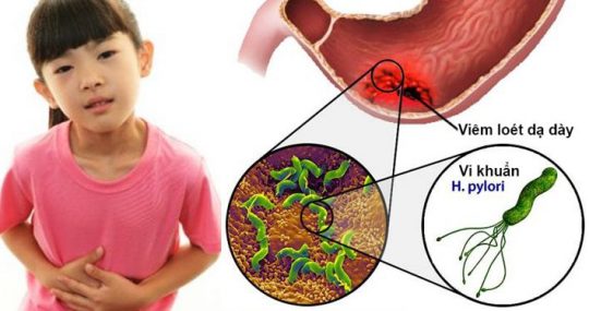 vi khuẩn hp ở trẻ em gây viêm loét dạ dày